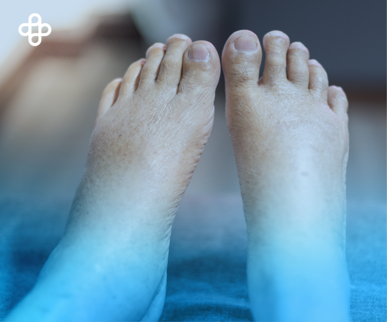 Descubre los Síntomas del Pie Diabético ¡Protege tu salud y actúa a