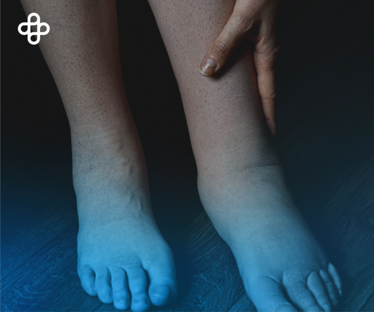 Descubre los Síntomas del Pie Diabético ¡Protege tu salud y actúa a